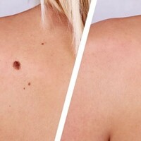 Электрохирургическая коагуляция доброкачественных образований кожи  1 штука до 0.5 см в диаметре - alwento.ru – Екатеринбург