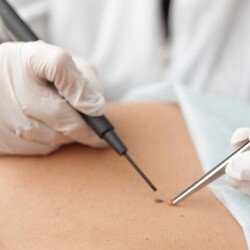 Электрохирургическая коагуляция и деструкция папиллом до 2 мм без учёта биопсии  до 3 штук - alwento.ru – Екатеринбург