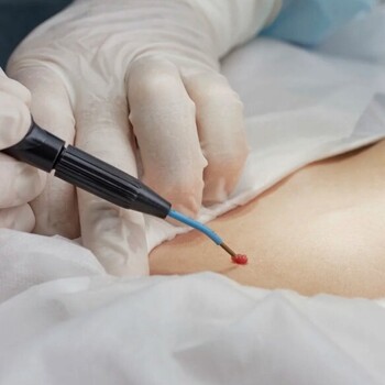 Электрохирургическая коагуляция и деструкция папиллом от 2 до 5 мм до 5 штук без учета стоимости биопсии - alwento.ru – Екатеринбург