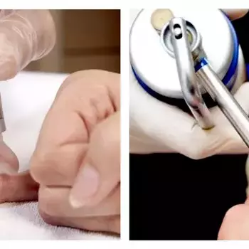 Криодеструкция бородавки, остроконечной кондилломы, контагиозного моллюска 1 штука до 2 мм в диаметре - alwento.ru – Екатеринбург