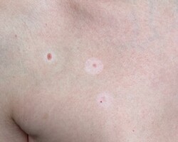 Галоневус ( невус Сеттона).  - alwento.ru – Екатеринбург